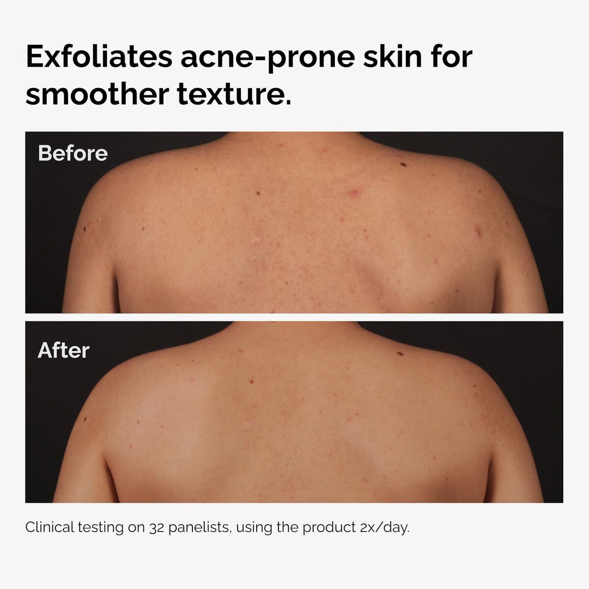 Acid 0.5% Body Serum - Ready Look